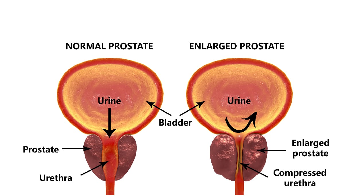 New trial will check men for prostate cancer even though they don’t ...