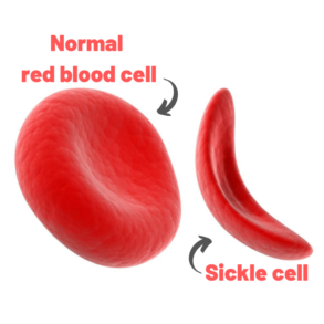 The world’s first gene therapy for sickle cell disease has been ...